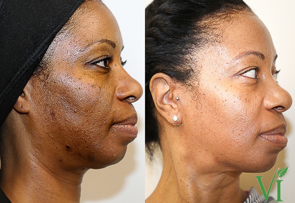 Hyperpigmentation Vi Peel Before And After