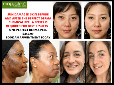 Chemical peels for sun damage Maryland