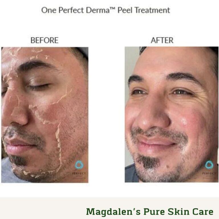 Before and After Perfect Derma Peel™ Treatment for Men