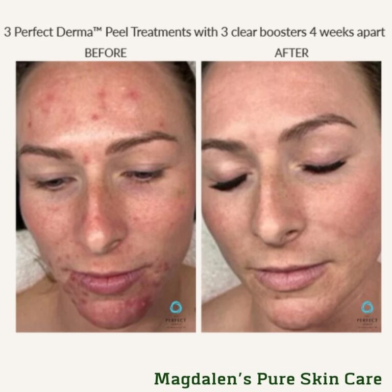 Before and After- perfect derma Peel™ with clear booster