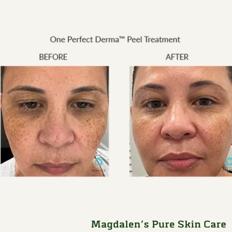 Perfect Derma Peel™ Treatment Results