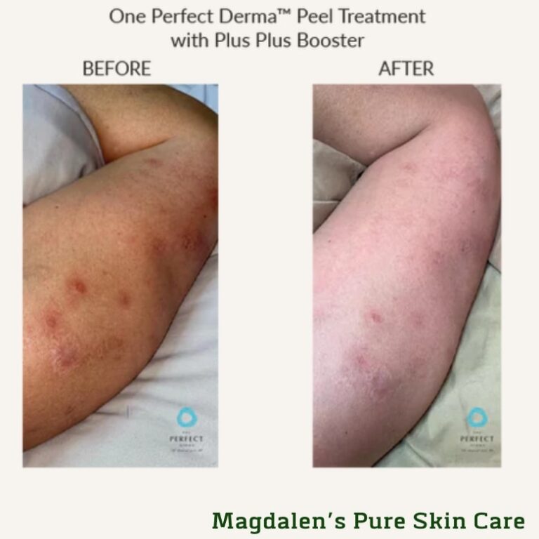 Perfect Derma Peel™ for Arms