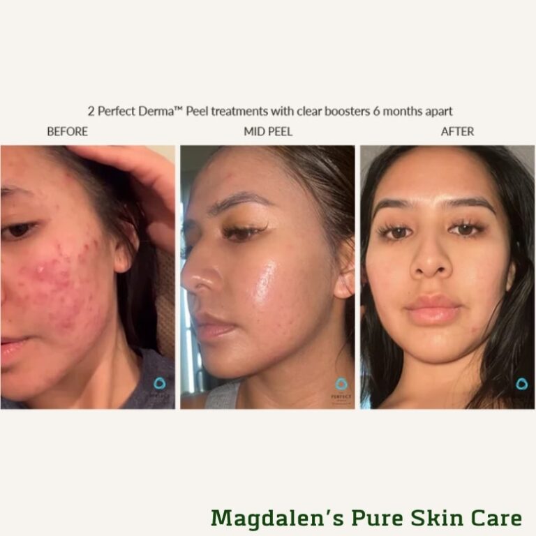 before and after perfect derma peel™ results