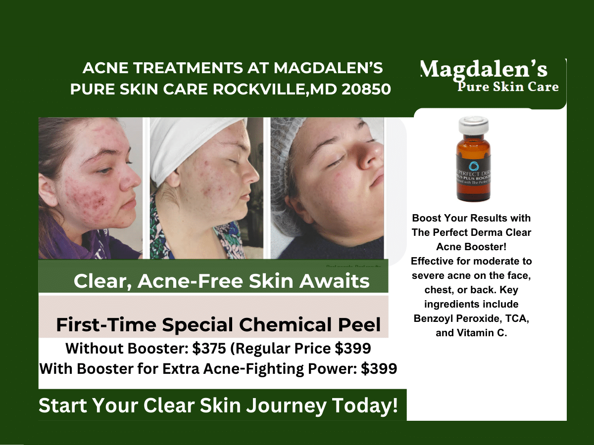 The Perfect Derma Peel in Rockville, MD