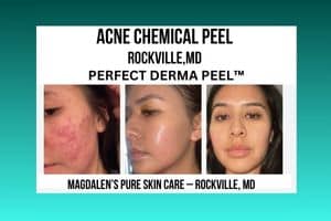 The Perfect Derma Peel in Rockville, MD