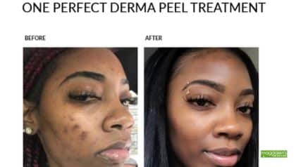Perfect Derma Peel before and after results in Rockville, MD, showing clearer, brighter skin
